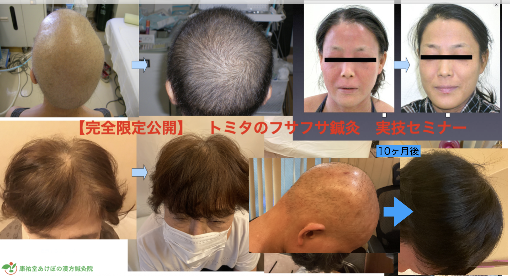 パーキンソン病 大阪 | トミタのフサフサ鍼灸セミナー2025