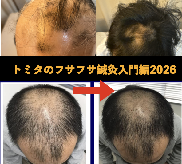 パーキンソン病 大阪 | 【4月17日フサフサ鍼灸セミナーオンライン入門編】