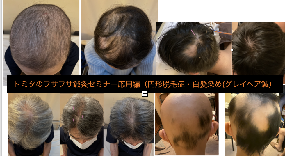 パーキンソン病 大阪 | 臨床トミタのふさふさ鍼灸【応用編】:難治性脱毛症・自己免疫疾患・毛髪エイジングケアへの挑戦