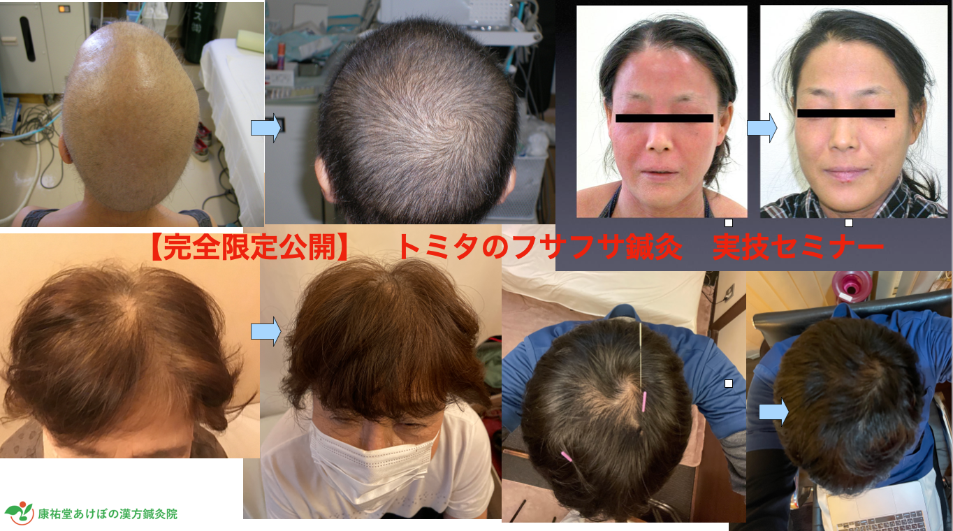 パーキンソン病 大阪 | トミタのフサフサ鍼灸実技セミナー
